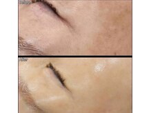 キュライム カブール町田店/見違える美しい肌に◎