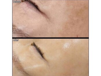 キュライム カブール町田店/見違える美しい肌に◎