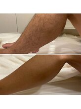 エクシア(excia)/メンズ足脱毛