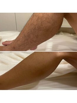 エクシア(excia)/メンズ足脱毛