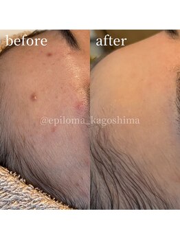 エピロマ(EPILOMA)/鹿児島市/宇宿/肌質改善