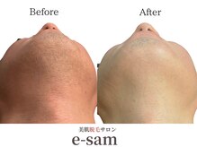 イーサム 高槻摂津富田店(e-sam)/髭脱毛