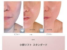 リアン(Lien)/40代 ビフォーアフター