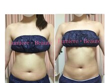 リュミエールボーテ/スリムキャビテーション