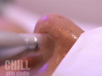 チル スキンスタジオ(CHILL skin studio)の写真/【毛穴をキレイにするならCHILL！！】毛穴美人続出♪毛穴のざらつき、黒ずみ、開きなどのお悩みも解決◎