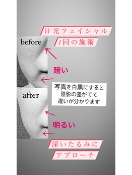 イーストモア(EAST MOIS)/W光フェイシャルでたるみ改善