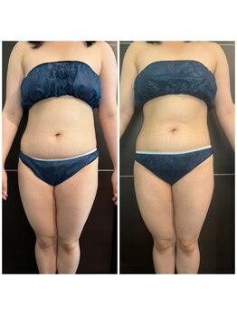 ネイルアンドリラクゼーション アン(nail&relaxation An)の写真/代謝を上げて老廃物の排出を促進していきます!理想のボディラインへ☆エリア希少な脂肪冷却◎