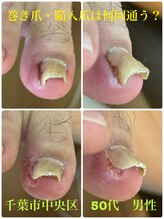 巻き爪じゅん 船橋店/巻き爪・陥入爪何回で良くなる？