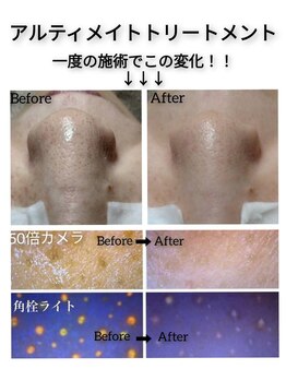 ポアレスサロン フィル(fil)/一度の施術結果