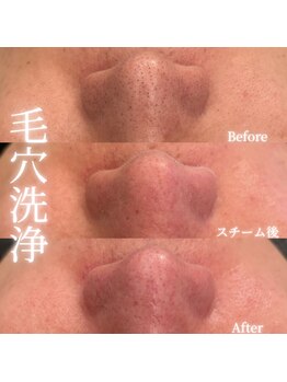 カリス(Charis)/毛穴洗浄