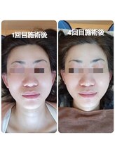 美藤鍼灸院/美容鍼のBefore After