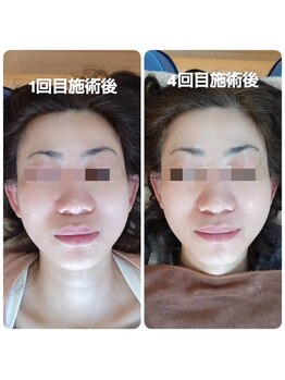 美藤鍼灸院/美容鍼のBefore After