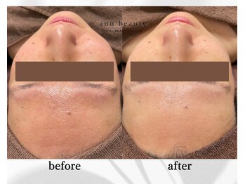 アン ビューティー(ann beauty)/施術1回【症例写真】30代女性