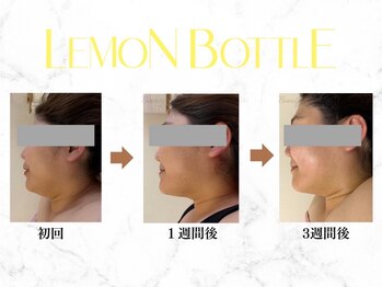 リルチェ 自由が丘(RILUCE)の写真/《話題の【レモンボトル】導入！》気になるお顔のたるみもスッキリ引き締めて、美しいフェイスラインに◎