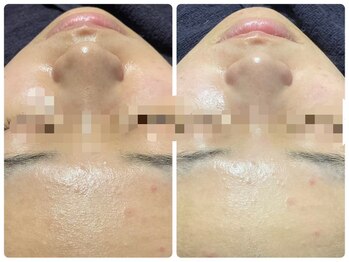 トータルビューティ ノイド(Noid)/毛穴洗浄 お試し全顔