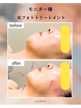 アミュレット(amulette)/光フォトトリートメント前後