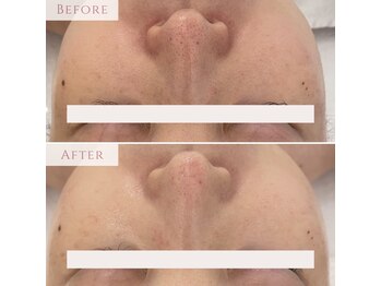 ミエル 神戸店(Miel)/エレクトロポレーション