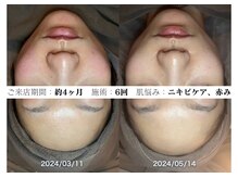 コキュウ(KOKYU)の雰囲気（肌育美容法を取り入れた剥けないピーリング/肌荒れ/毛穴/跡/赤み）