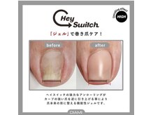 ネイルズシャトン/ジェルで巻爪ケア