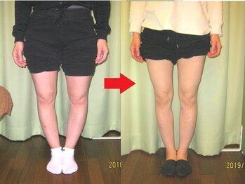 チャラク(charaku)/【30代M様：O脚矯正・骨盤矯正】