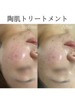 ビューティービューティー(BEAUTY BEAUTY)/陶肌トリートメント