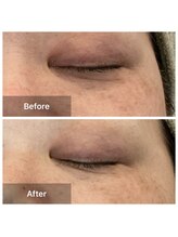 ルミエール(Lumiere)/４０代　クマ、くすみ改善