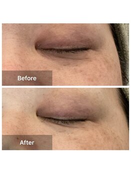 ルミエール(Lumiere)/４０代　クマ、くすみ改善