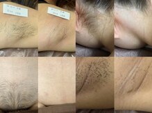 プリマ(Prima)の雰囲気（【脱毛】↑施術1回のBEFORE&AFTER純国産機使用で効果に自信あり）