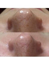 サロンビューティー美優/毛穴の黒ずみ・ハーブピーリング