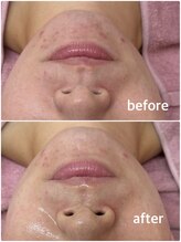 リエル(Liel)/ダクトピール1回目 before/after