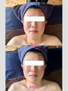 レーヌ(Reine)/フェイスラインがスッキリ