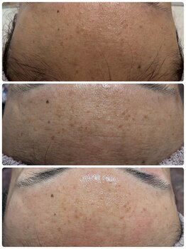 エルナ(Eluna)/美肌覚醒プログラム セルマン