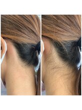 ビオラス(VIOLUS)/【まるっと全身脱毛】陶器肌へ☆