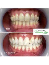 ホワイトニングサロン 名古屋駅店/【ホワイトニング施術例】