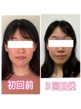 小顔矯正サロン ブルーム/施術3回のビフォーアフター