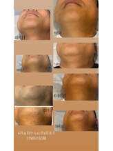 ラヴィエール(Laviere)/【メンズ脱毛】お顔