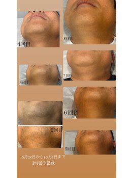 ラヴィエール(Laviere)/【メンズ脱毛】お顔