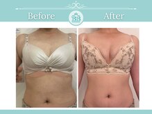 美人バスト 名古屋店/【バストアップ】症例☆