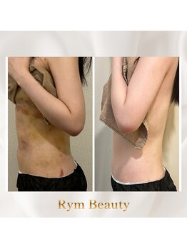 リム ビューティー(RYM BEAUTY)/インディバボディ術後ケア
