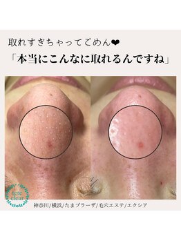 エクシア(Excia)/毛穴洗浄