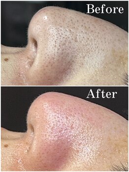 ティーツリー 名古屋 桜山(Tea Tree)/どんな毛穴汚れも一層