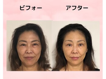 美カナエル(美kanaeru)/導入！エイジングケア☆