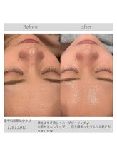 ラルーナ(LA LUNA)/ハーブピーリング1回目
