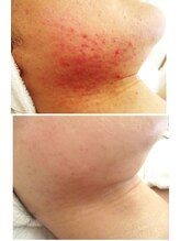 サロンドエステケイワイ(de KY)/フェイシャル☆アゴ下ニキビ改善