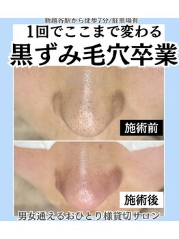 脱毛マックス 南越谷店(MAX)/毛穴エクストラクションプロ