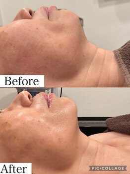 ウォーム(Warm)/60代女性　フラクショナル施術例