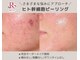 laksmi【肌質改善専門店】毛穴/ニキビケア/赤み/ハーブピーリング/プラズマニアの写真