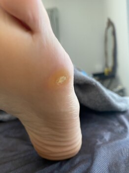 グリーングリーン(GREEN GREEN)/痛みの伴う魚の目お悩みbefore