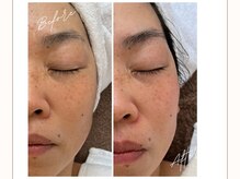 ポーラ プライベートサロンLino店(POLA)/ビフフォーアフター