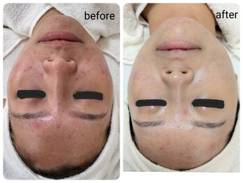 レゾン 京橋店/【ビフォーアフター】ニキビケア